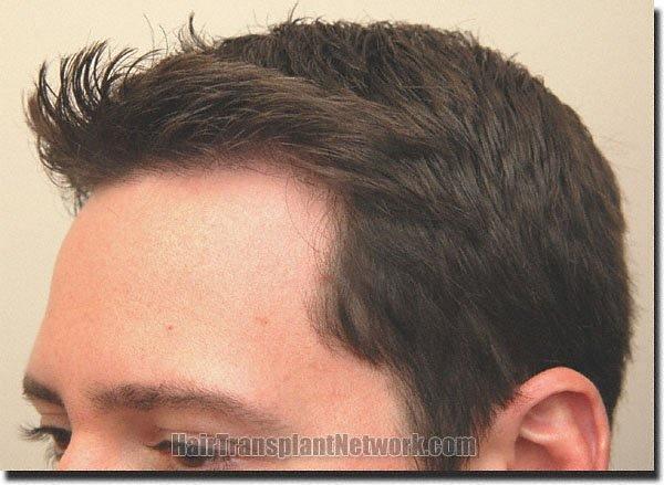 Hair restoration procedure results