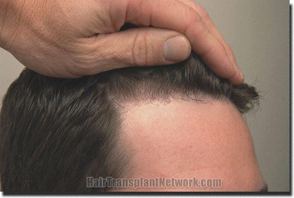 Hair restoration procedure results