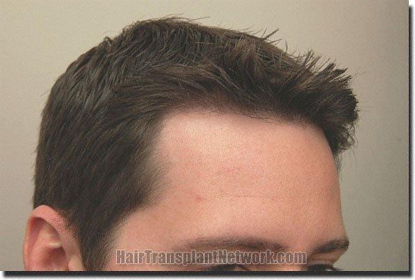 Hair restoration procedure results