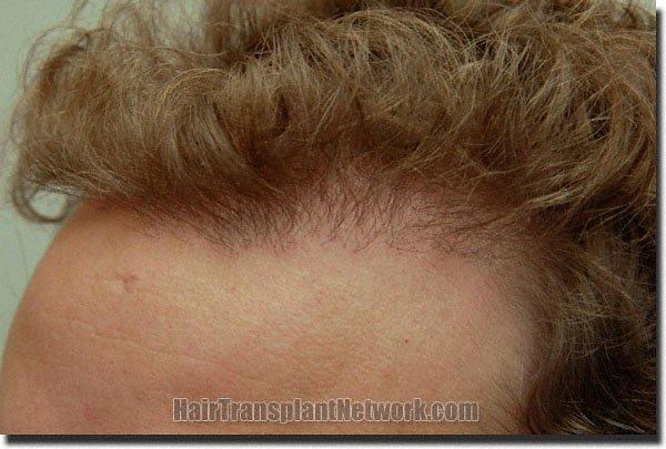 Hair restoration procedure results