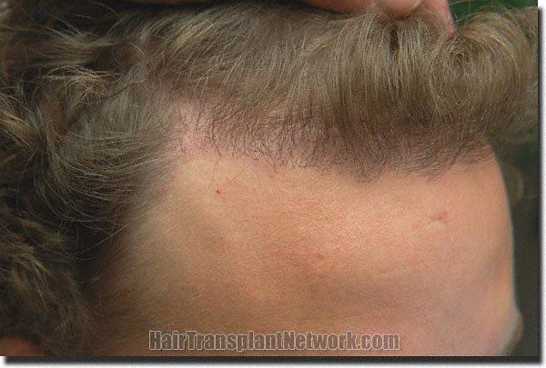 Hair restoration procedure results