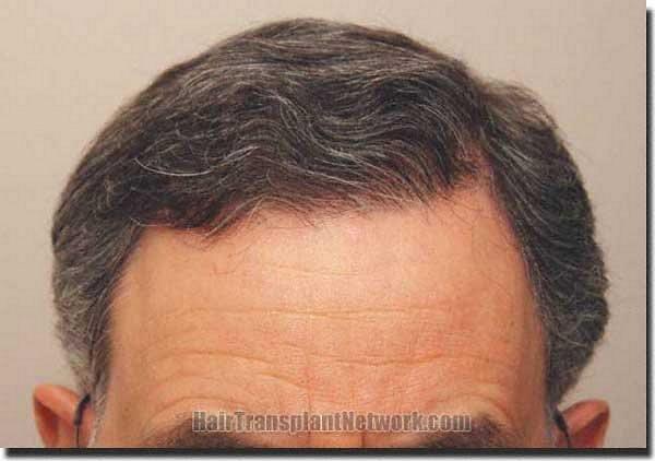 Hair restoration procedure results