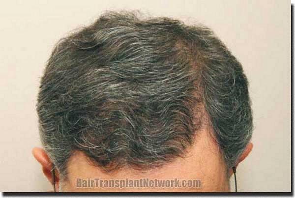 Hair restoration procedure results