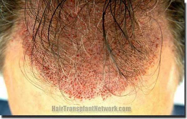 Hair restoration procedure results