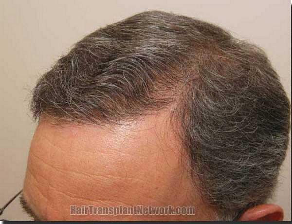 Hair restoration procedure results