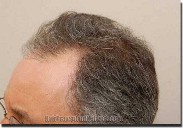 Hair restoration procedure results