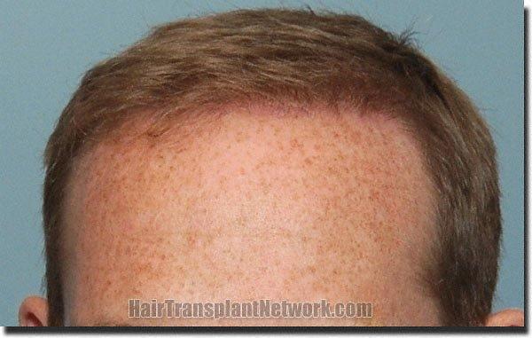 Hair restoration procedure results