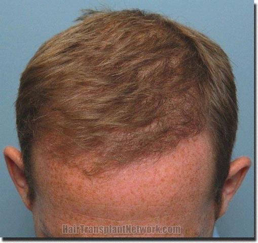 Hair restoration procedure results