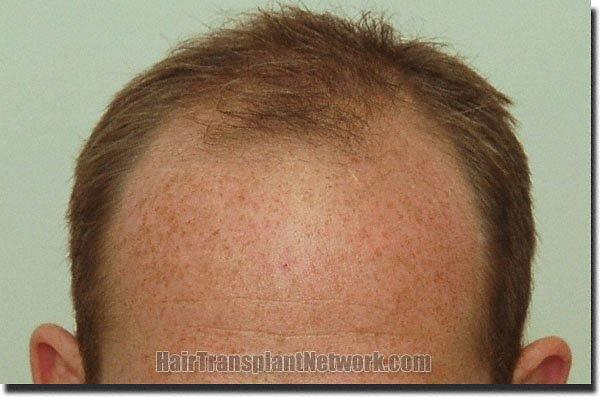 Hair restoration procedure results