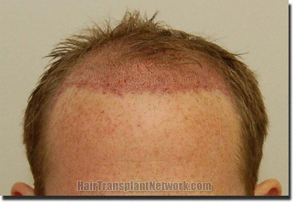 Hair restoration procedure results