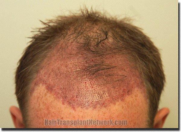 Hair restoration procedure results