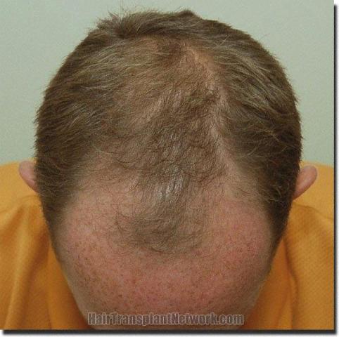 Hair restoration procedure results