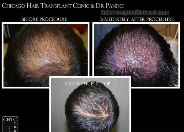 Hair restoration procedure before and after results