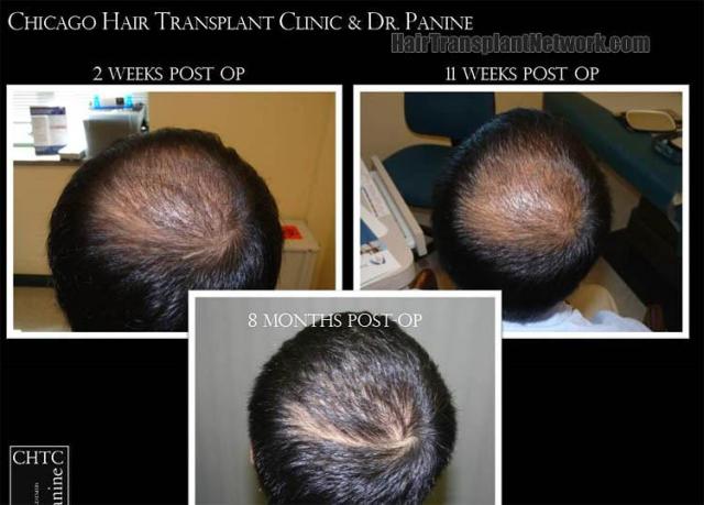 Hair transplantation surgery before and after photos