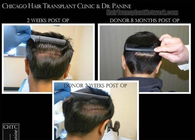 Hair transplantation surgery before and after images