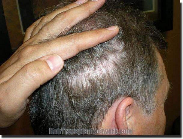 Hair restoration procedure results