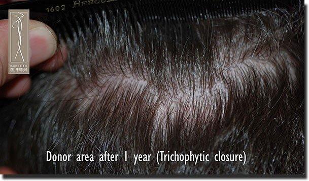 Hair restoration procedure results