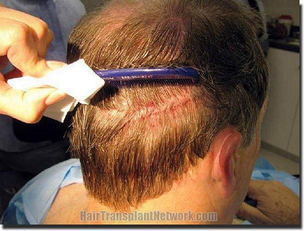 Hair restoration procedure results