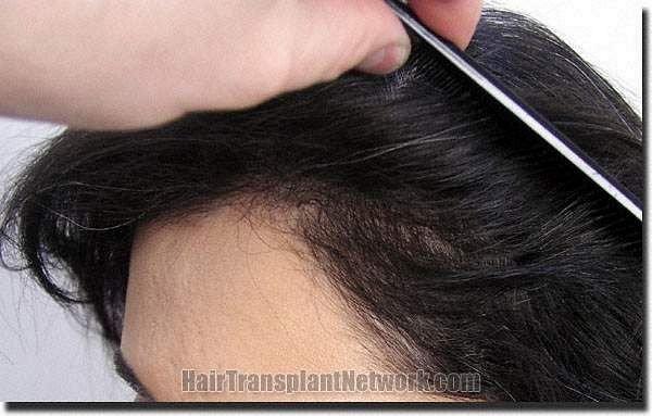 Hair restoration procedure results