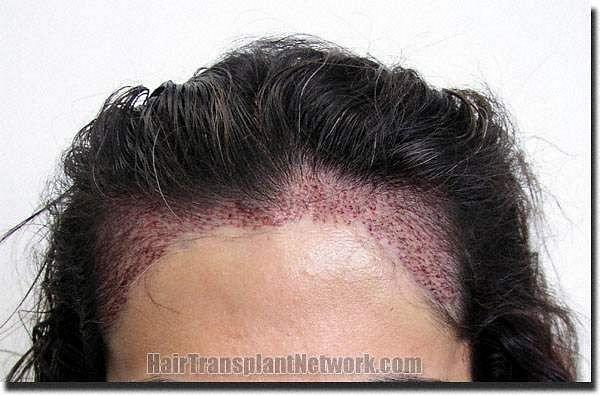 Hair restoration procedure results