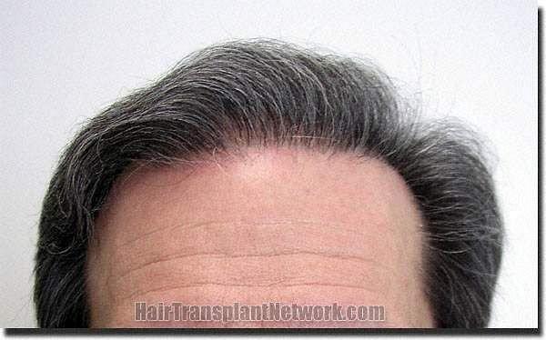 Hair restoration procedure results