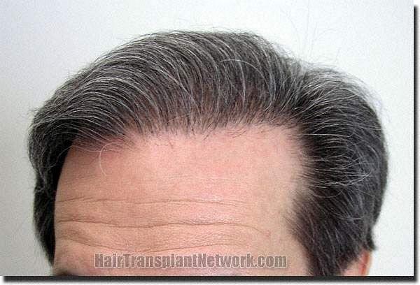 Hair restoration procedure results