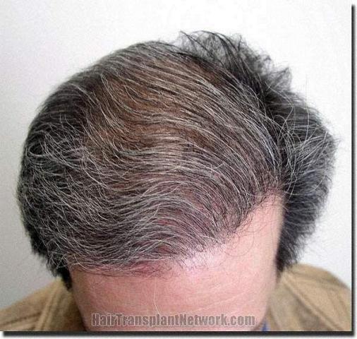 Hair restoration procedure results