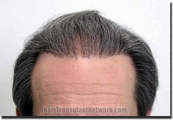 Hair restoration procedure results