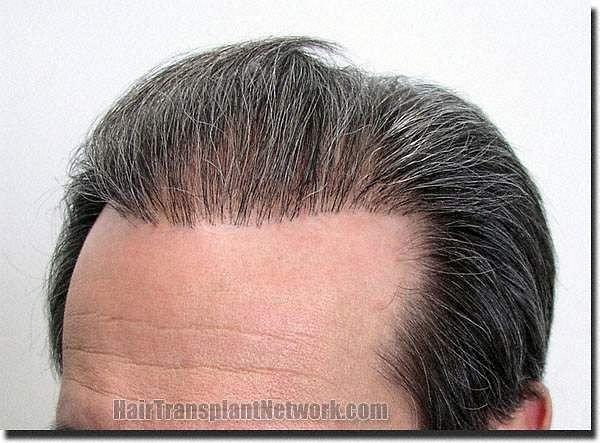 Hair restoration procedure results