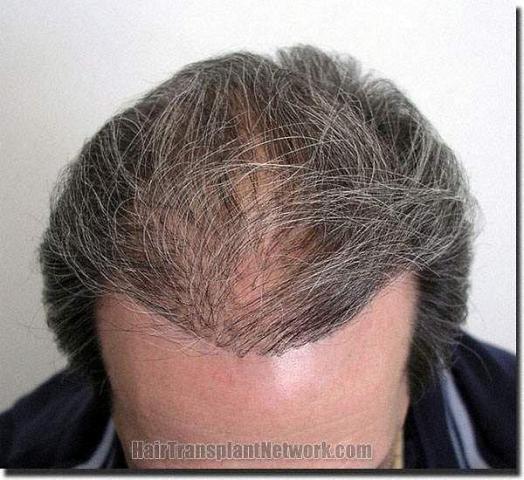 Hair restoration procedure results