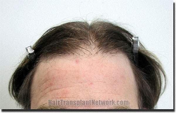 Hair restoration procedure results