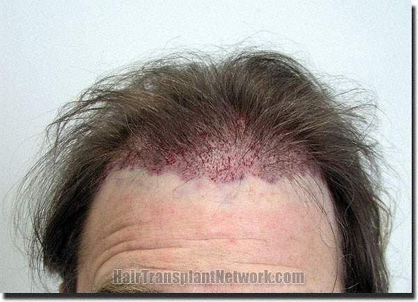 Hair restoration procedure results