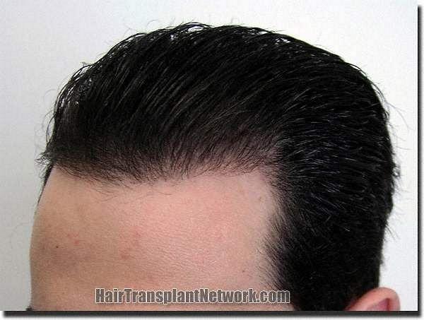 Hair restoration procedure results