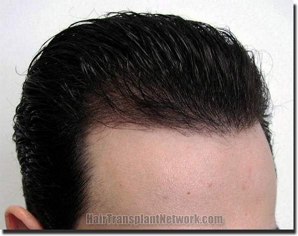 Hair restoration procedure results