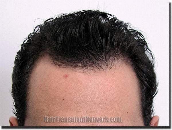 Hair restoration procedure results