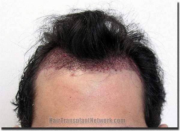 Hair restoration procedure results