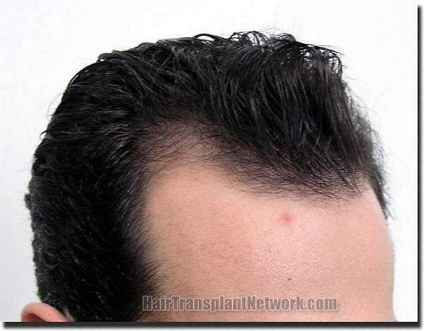 Hair restoration procedure results