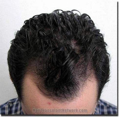 Hair restoration procedure results