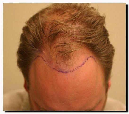 Hair restoration procedure results