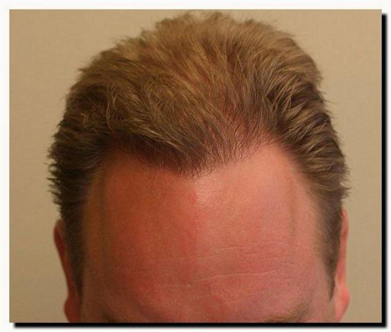 Hair restoration procedure results