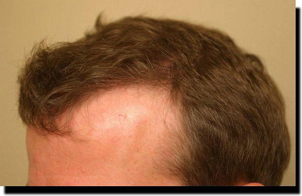 Hair restoration procedure results