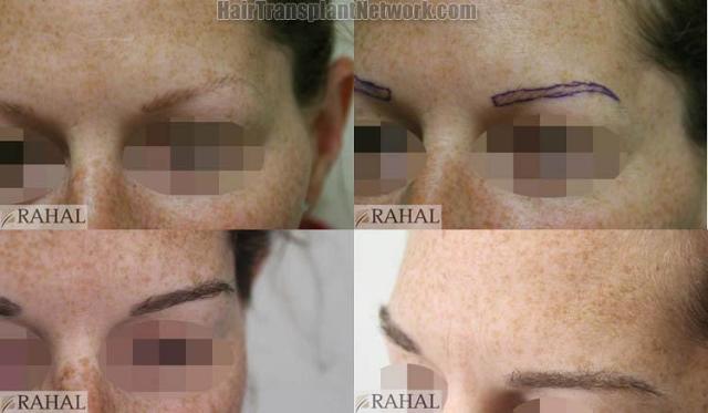 Eyebrow transplantation surgery before and after images