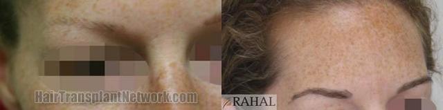 Eyebrow transplantation surgery before and after photos