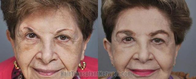 Hair restoration procedure before and after results