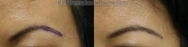 Before and after female eyebrow transplant surgery