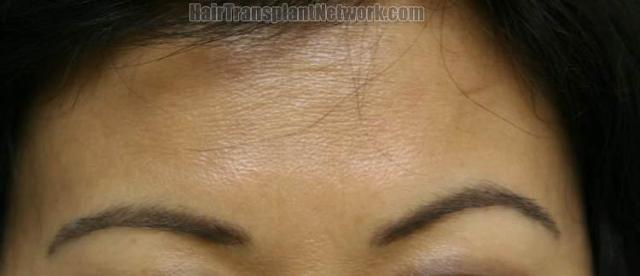 Female eyebrow transplant surgery before and after