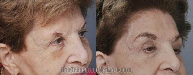 Hair transplantation surgery before and after photos