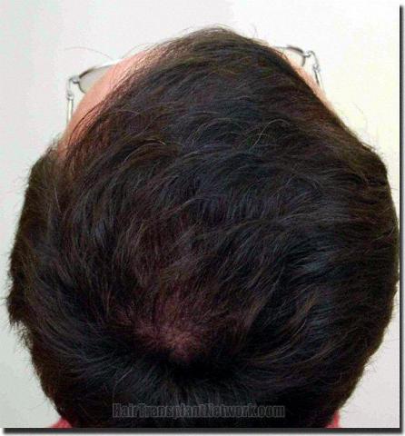 Hair restoration procedure results