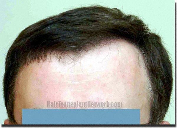 Hair restoration procedure results