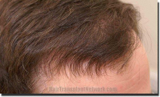 Hair restoration procedure results